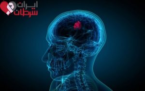 علائم تومور مغزی