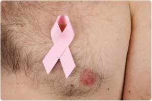 سرطان پستان در مردان