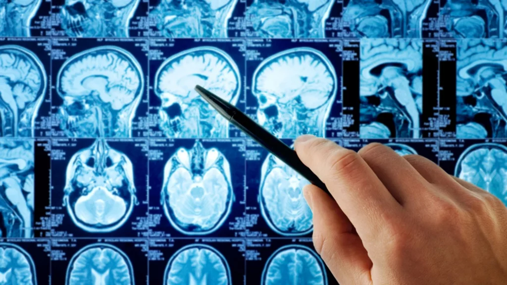 تشخیص تومورهای مغزی اولیه و ثانویه