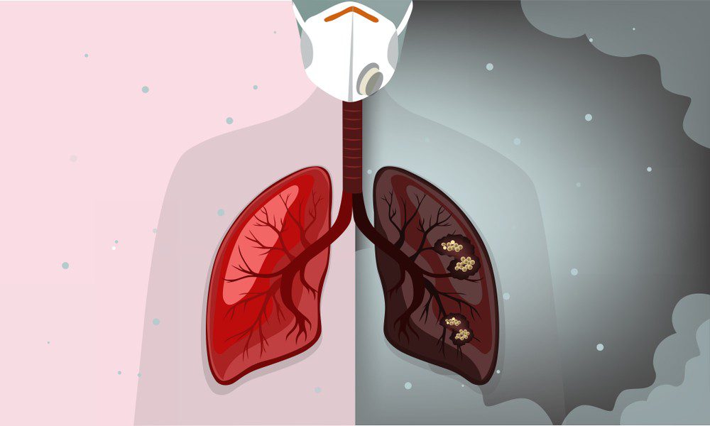 تاثیر آلودگی هوا بر سرطان ریه